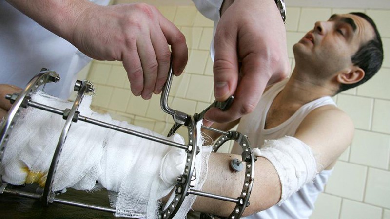 Уральские ученые нашли эффективный способ для лечения переломов

