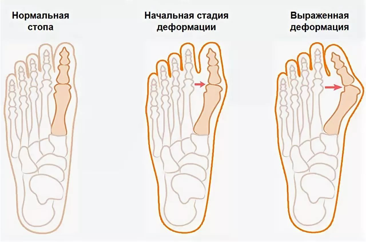 Вальгусная деформация первого пальца стопы