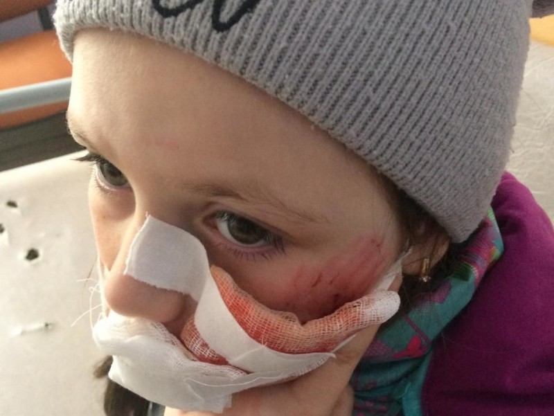 9-летняя девочка из Нижнего Одеса после нападения собаки направлена в Ухтинскую горбольницу
