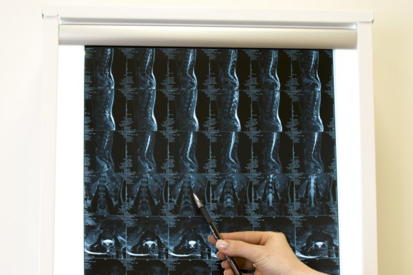 Мнение врача: для кого особенно опасны зимние переломы и как от них защититься