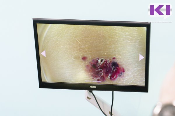 Онколог Стилиди рассказал, что удалять родинки 