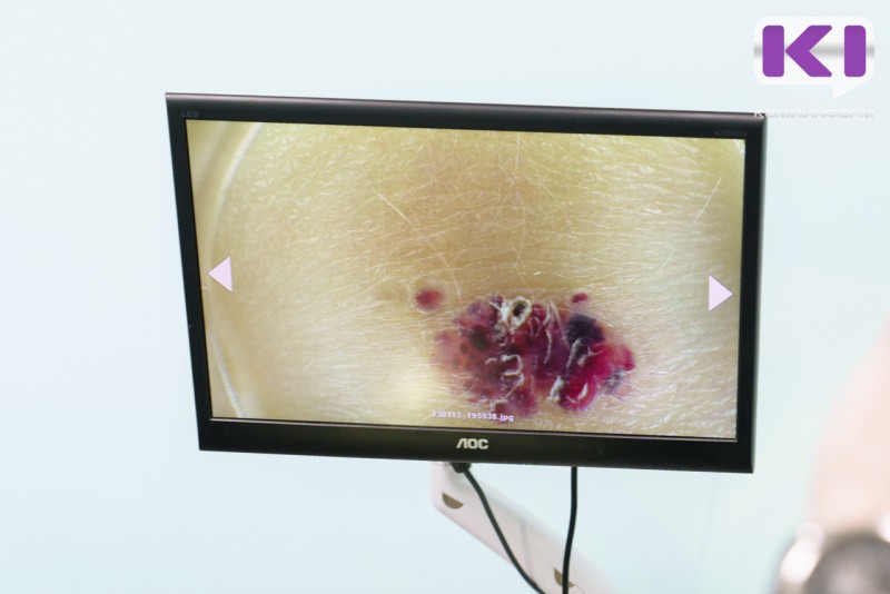 Онколог Стилиди рассказал, что удалять родинки "про запас" бессмысленно