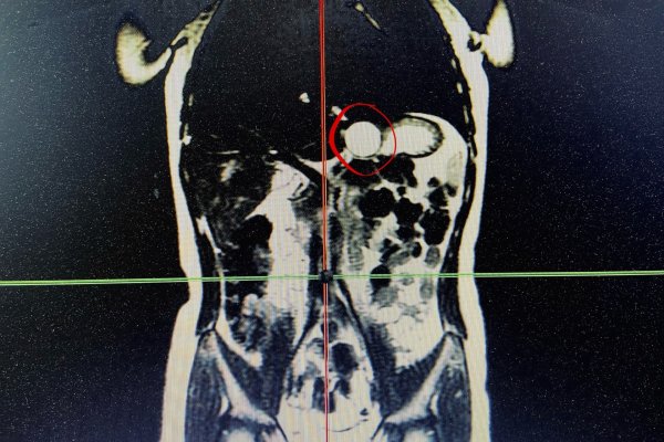Редкое заболевание выявили у семилетней сыктывкарки на диспансеризации 