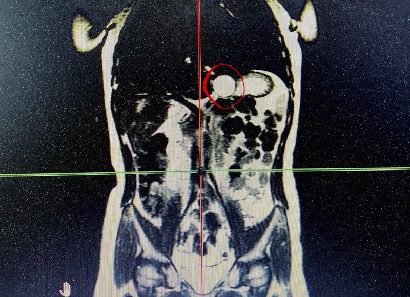 Редкое заболевание выявили у семилетней сыктывкарки на диспансеризации 