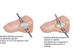 Опыт применения операции McBride при оперативном лечении