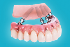 Имплантация зубов по методу All-on-4